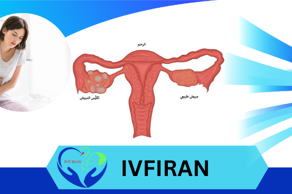 أكياس على المبيض