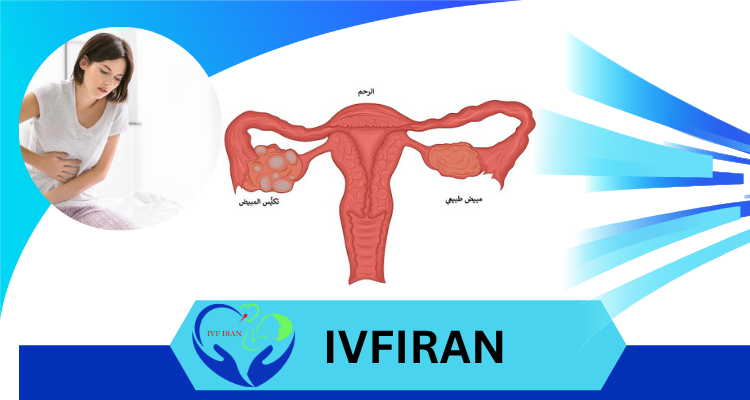 أكياس على المبيض